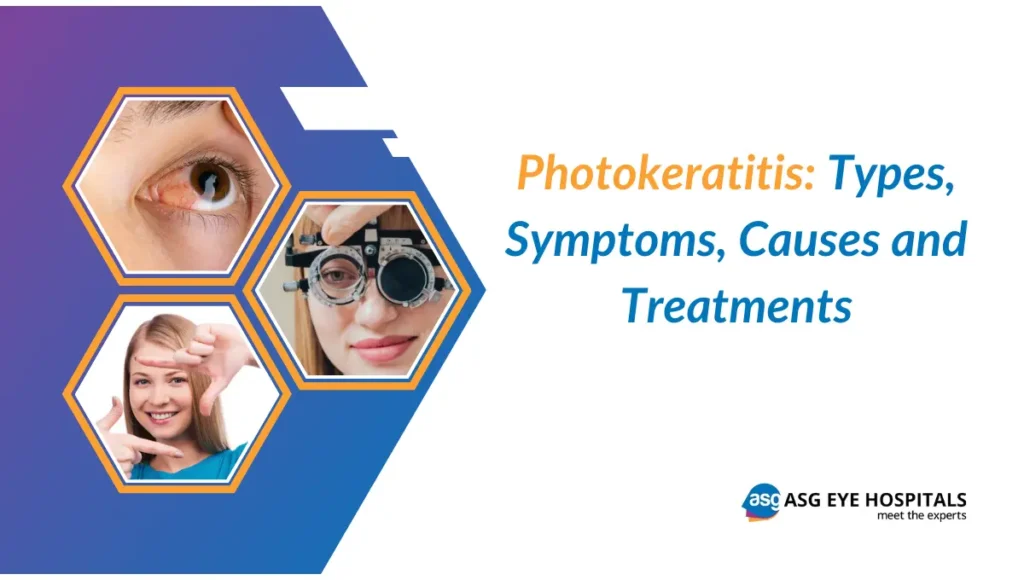 Photokeratitis Symptoms