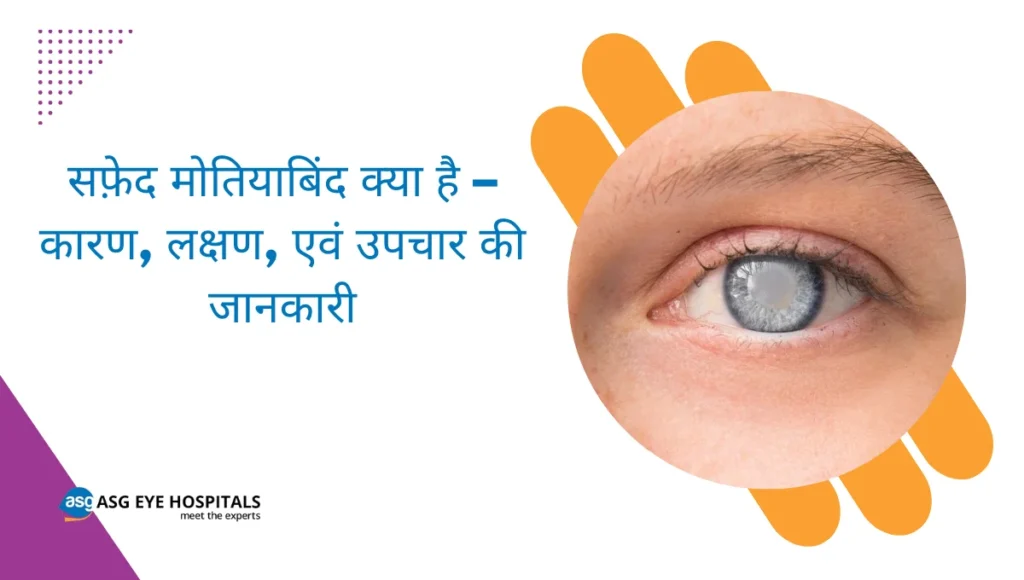 सफ़ेद मोतियाबिंद क्या है – कारण, लक्षण, एवं उपचार की जानकारी