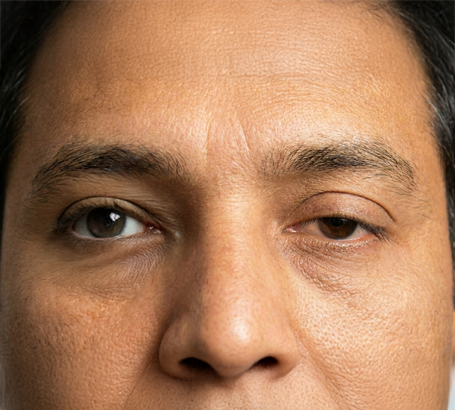 Drooping or sagging eyelids affecting vision