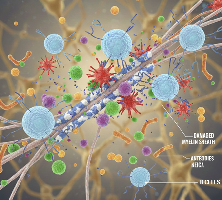 Neuro-Ophthalmology_CommonCauses_Autoimmune-diseases-such-as-multiple-sclerosis
