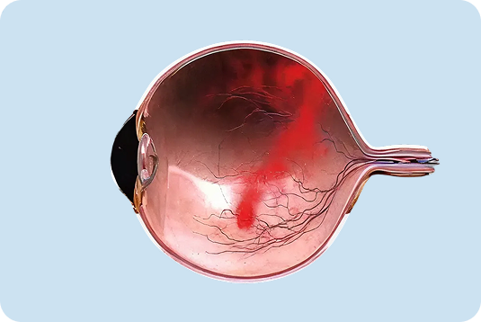 Retina and Associated Diseases