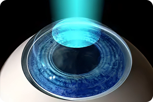 What is Photorefractive Keratectomy?