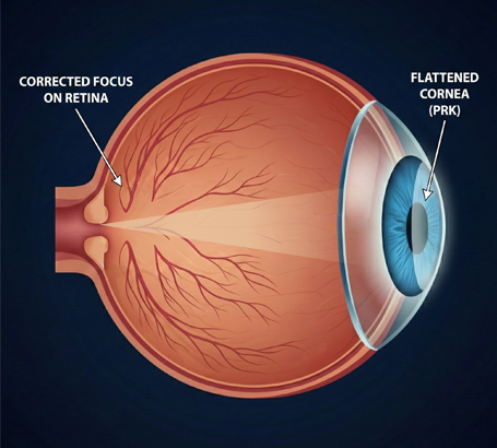 Myopia (nearsightedness):