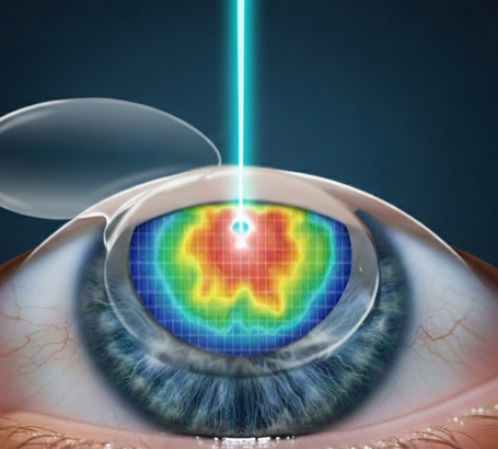 1_Types-of-contoura Lasik_Topography-Guided LASIK
