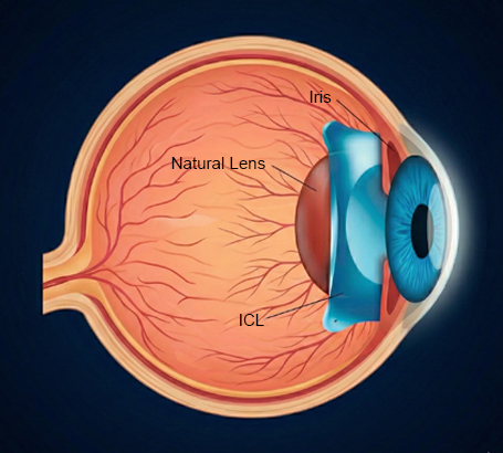 Made of Collamer (collagen + copolymer) — well tolerated with minimal inflammation.