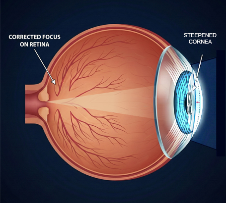 Hyperopia (farsightedness):