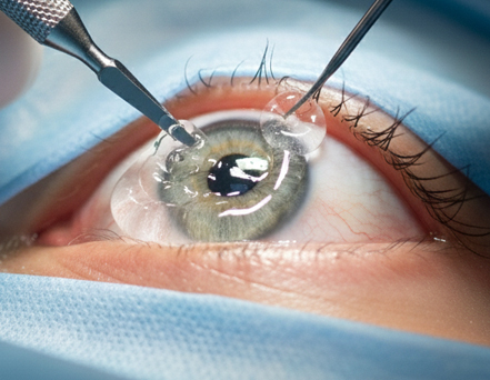 Small corneal incision made; lubricant protects the cornea.