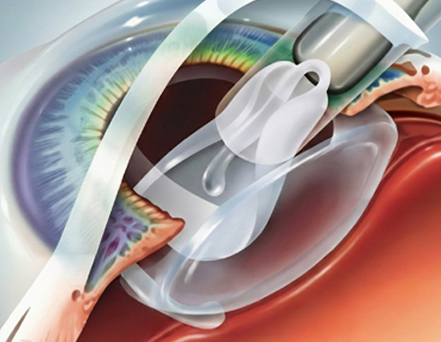 The folded ICL is inserted through a cartridge and positioned behind the iris, in front of the natural lens.
