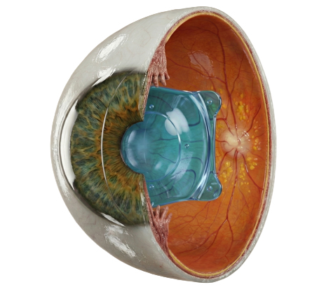 Phakic Intraocular Lenses (Phakic IOLs):