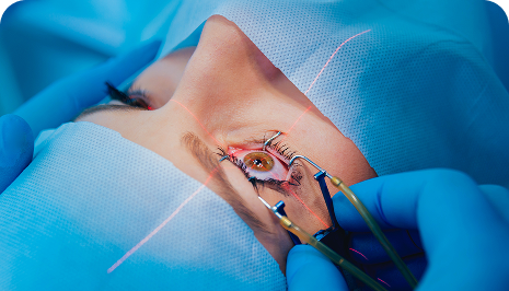 LASIK Surgery