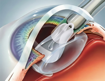 Micro-Incision Cataract Surgery (MICS)